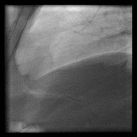 http://zlatokop.medicon.cz/csp/docminer/dicom/images/XA.1.3.12.2.1107.5.4.5.35372.30000011080810404120300002166.512.W1.jpg.0.jpg